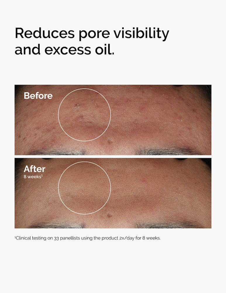 The Ordinary Niacinamide 10% + Zinc 1% Siero - immagine 5 The Ordinary Niacinamide 10% + Zinc 1% Siero - immagine 5